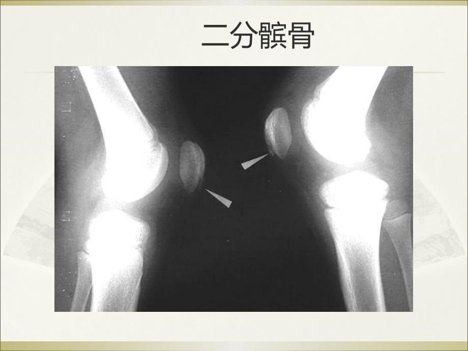 骨肿瘤鉴别诊断攻略课件_第5页