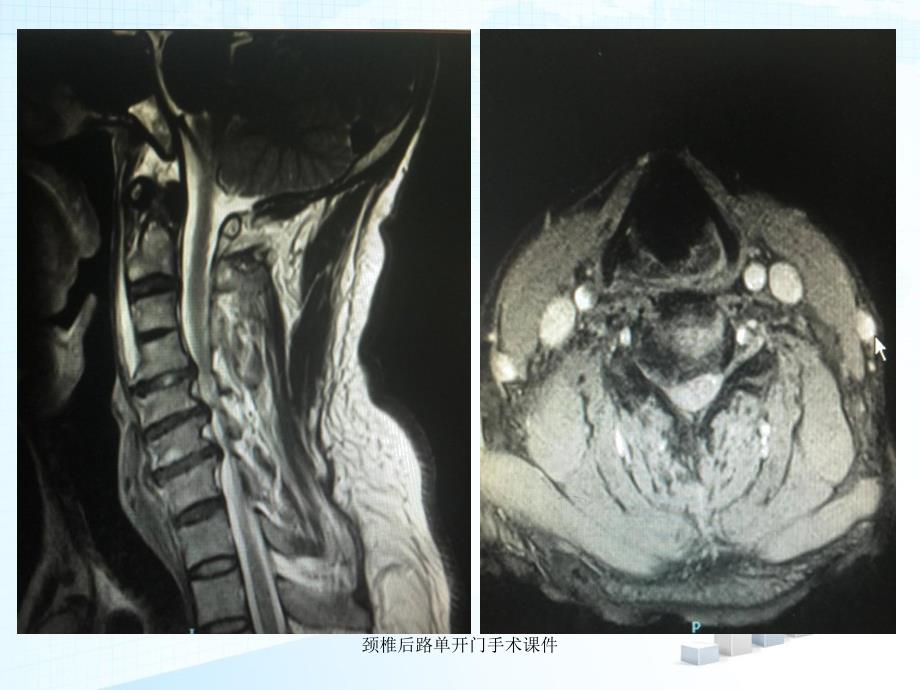 颈椎后路单开门手术课件_第3页