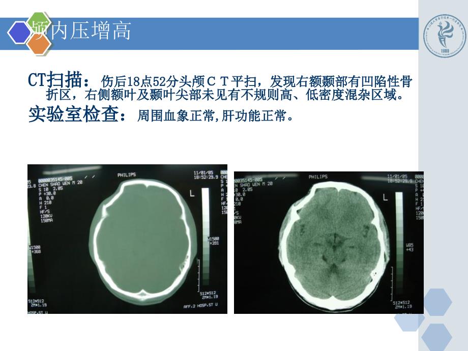 已编新颅脑损伤病例精选文档_第4页