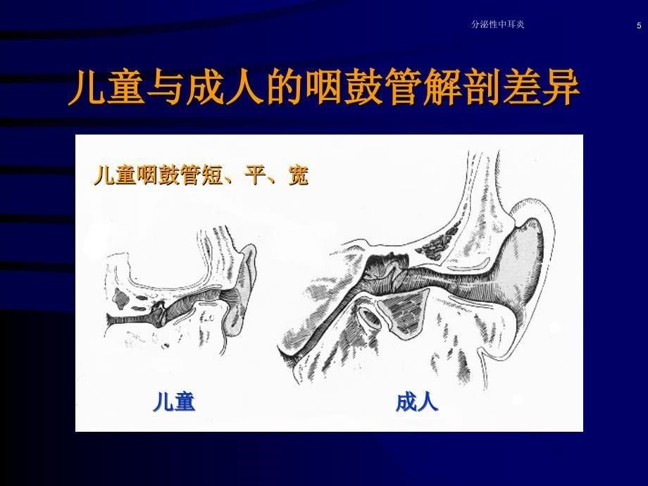 分泌性中耳炎PPT演示幻灯片_第5页