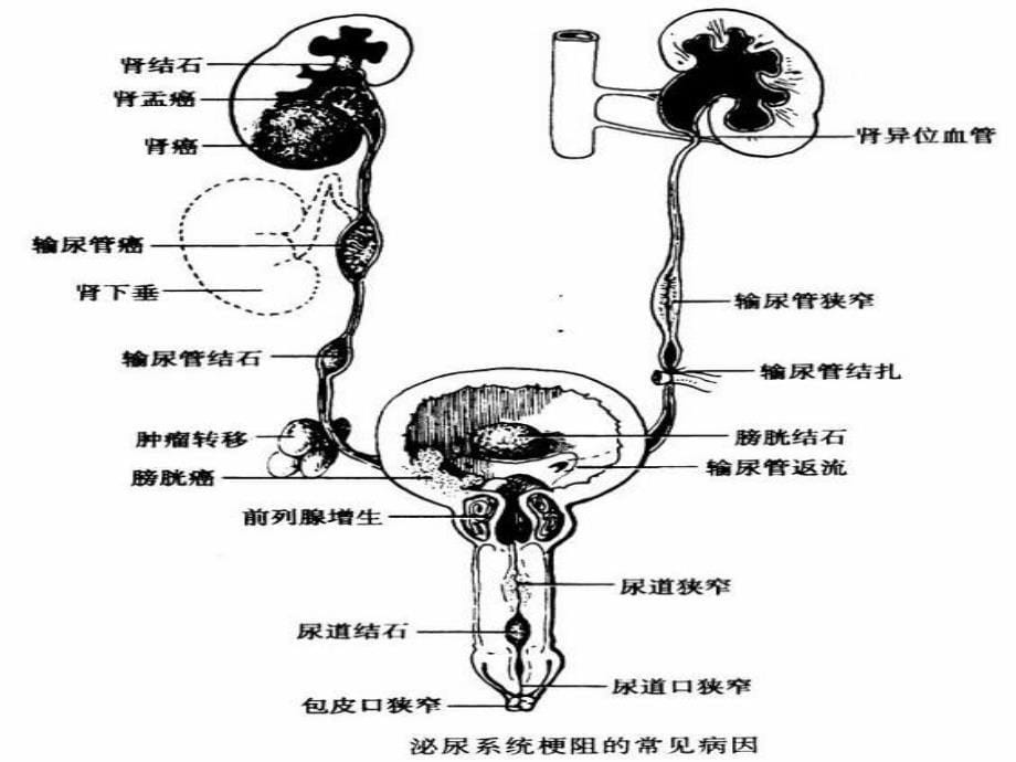 泌尿系感染护理查房_第5页