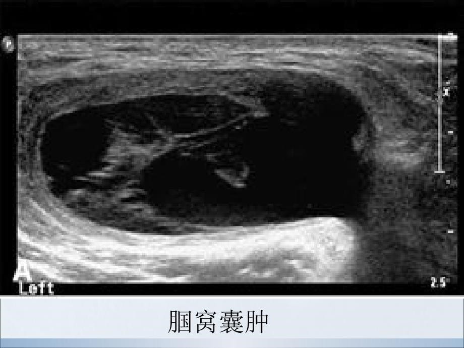 肌肉软组织肿物的超声诊断_第5页