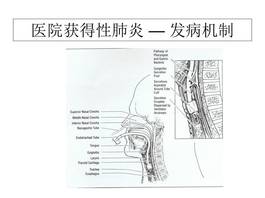 医院获得性肺炎的预防_第5页