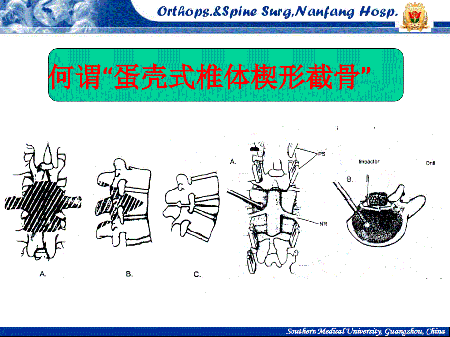 临床医学]蛋壳式椎体楔形截骨矫治脊柱后凸 南方医科大学南方医院脊柱骨病外科 王吉兴_第2页