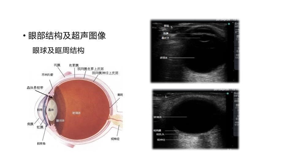 视神经鞘直径与颅内压.ppt_第5页