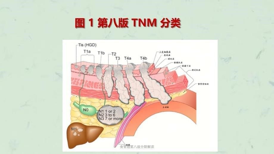 食管癌第八版分期解读课件_第5页