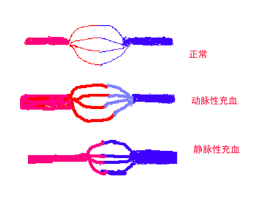 病理学第三章局部血液循环障碍_第4页