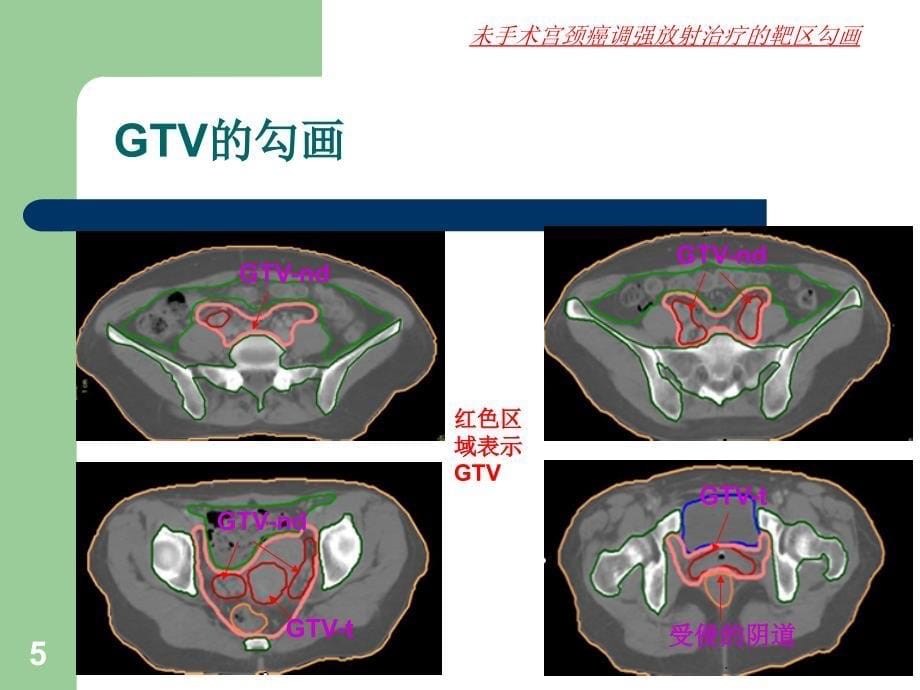 (医学文档)宫颈癌靶区勾画ppt演示课件_第5页