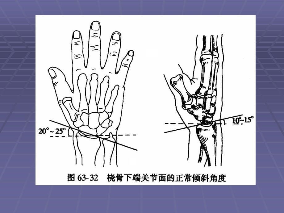 桡骨远端骨折手术治疗._第5页