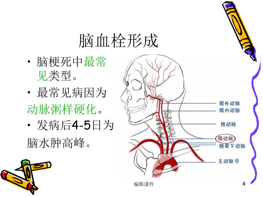 缺血性脑卒中的护理课件_第4页