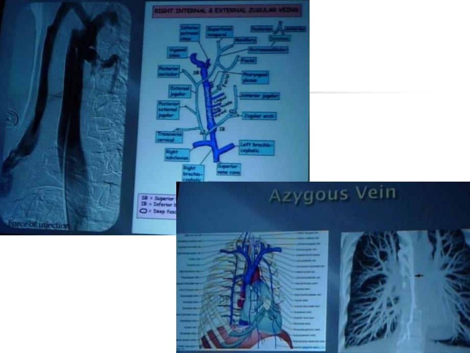 慢脑脊髓静脉功能不全CSVI与多发硬化MS_第4页