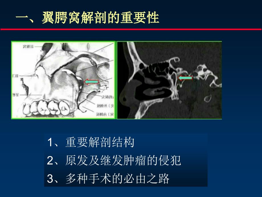 翼腭窝解剖--msct-_第2页