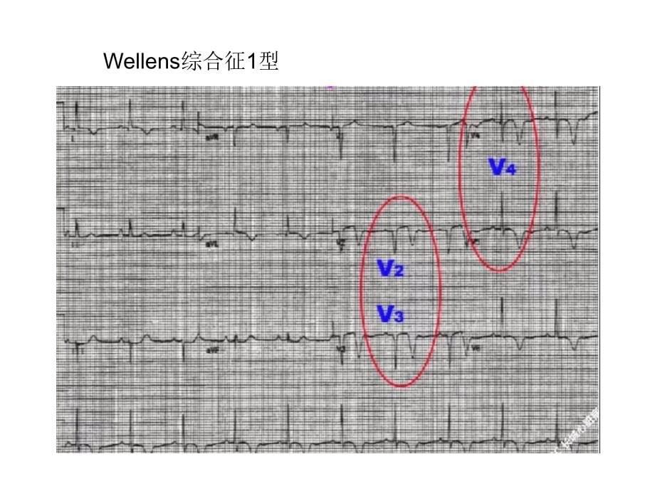 急性心肌梗死不典型图形汇总_第5页