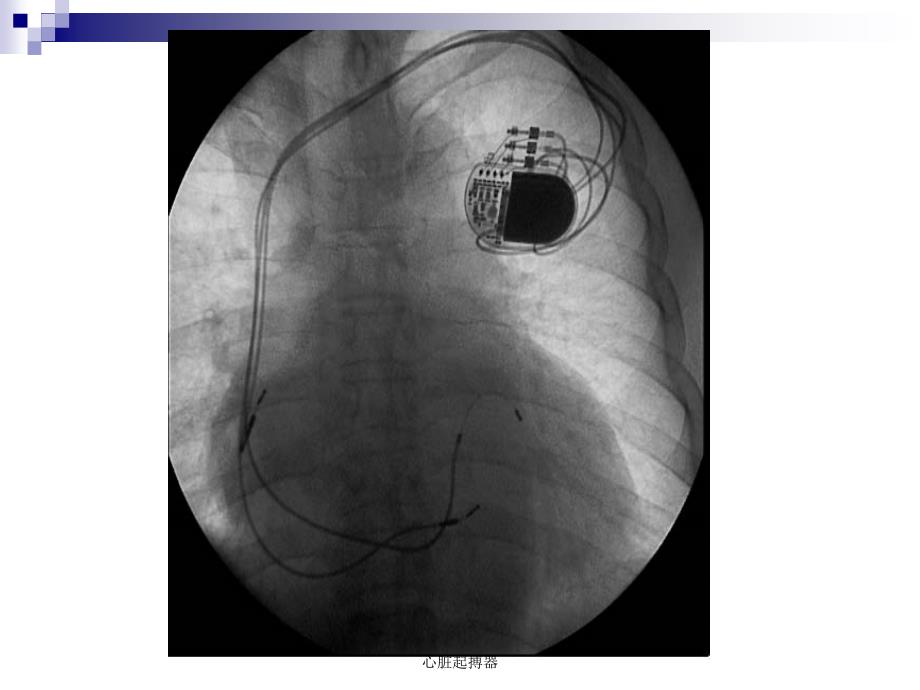 心脏起搏器课件_第3页
