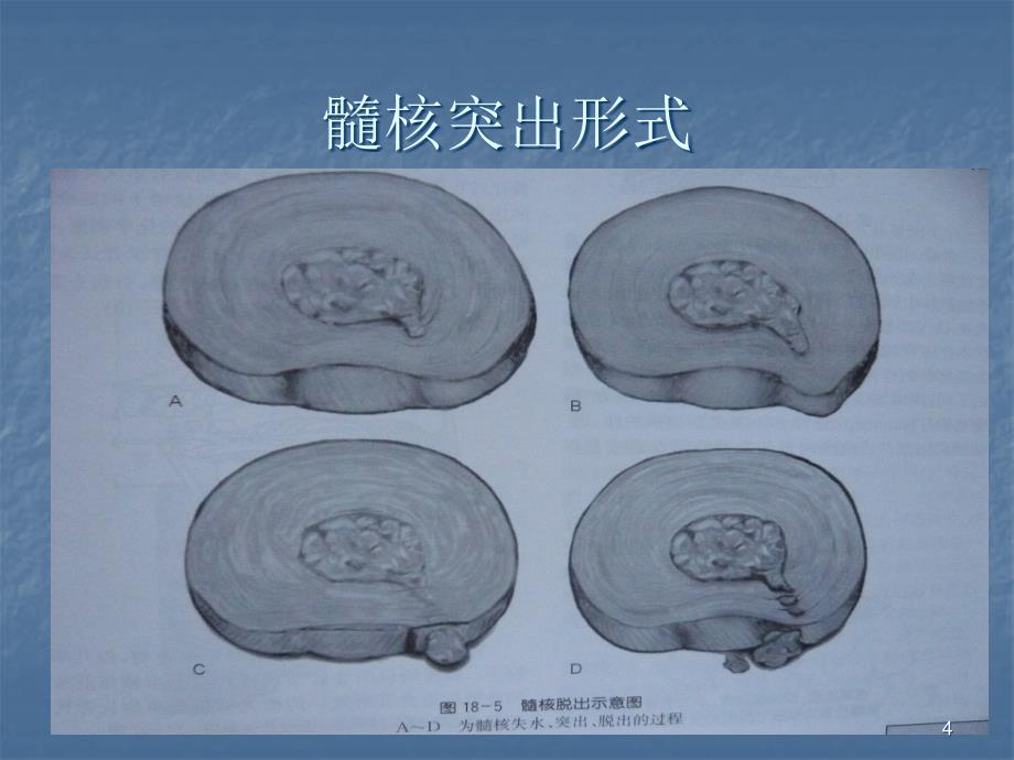 颈椎病的分型及诊断PPT课件_第4页