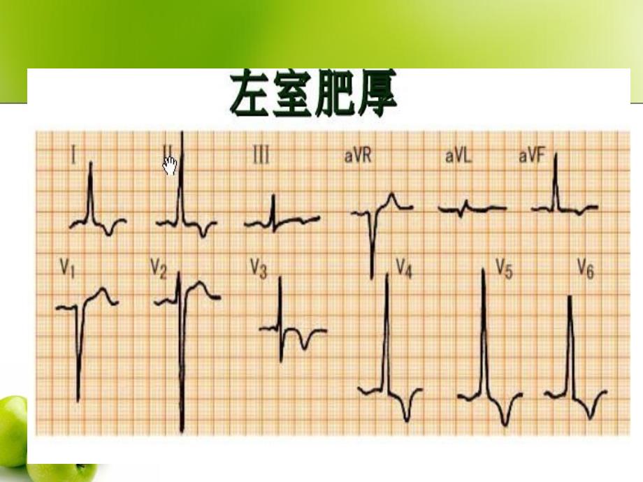 第八节原发性高血压文档资料_第4页