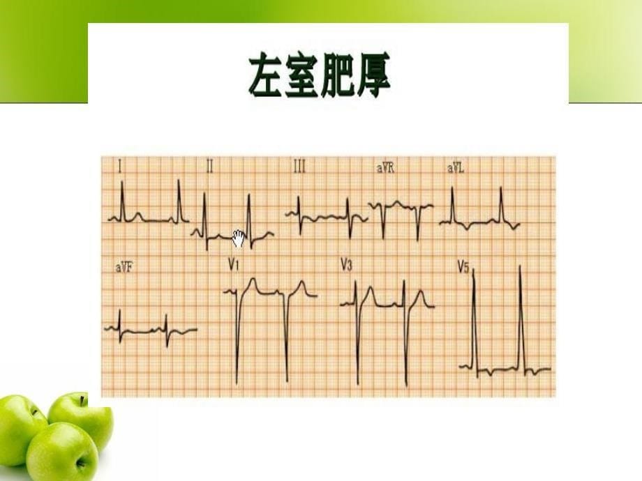 第八节原发性高血压文档资料_第5页