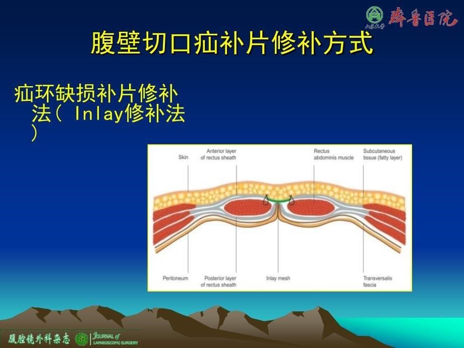 腹腔镜腹壁切口疝修补术_第5页