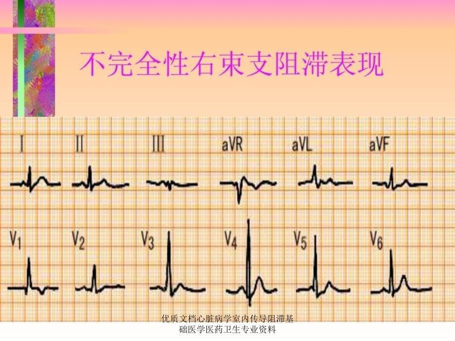 优质文档心脏病学室内传导阻滞基础医学医药卫生专业资料课件_第5页