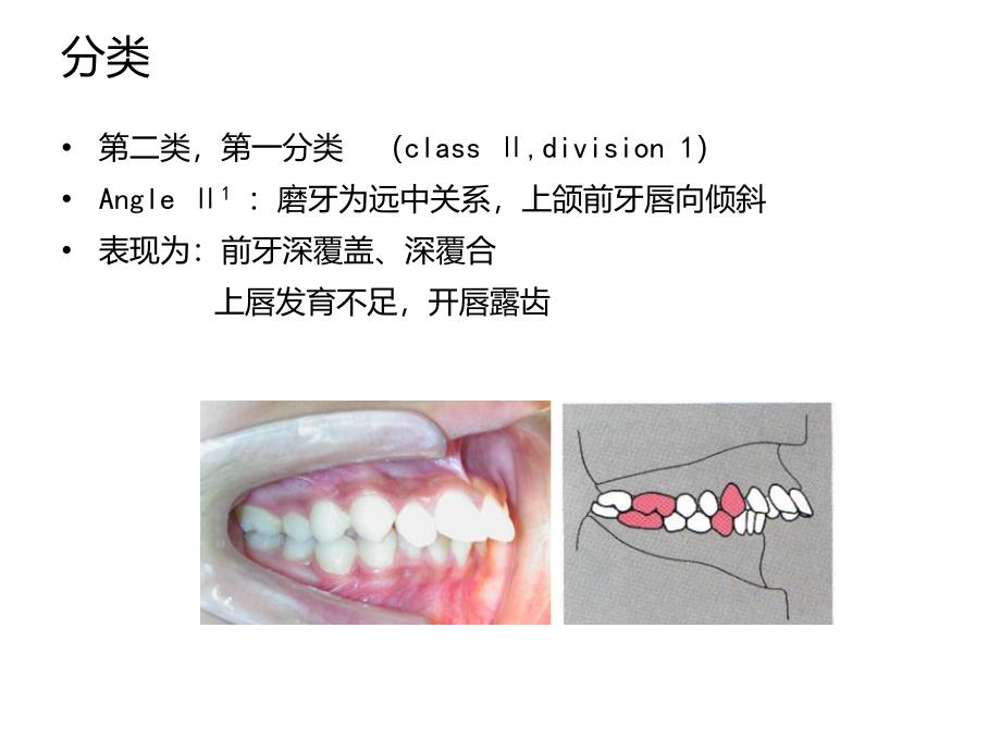 安氏II类错合的矫治课件_第4页