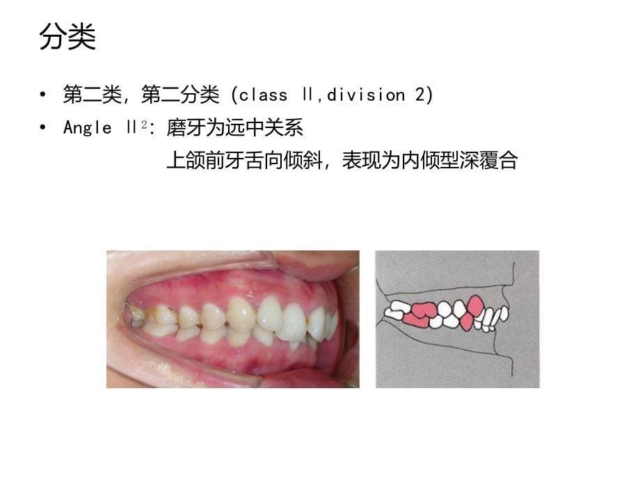 安氏II类错合的矫治课件_第5页