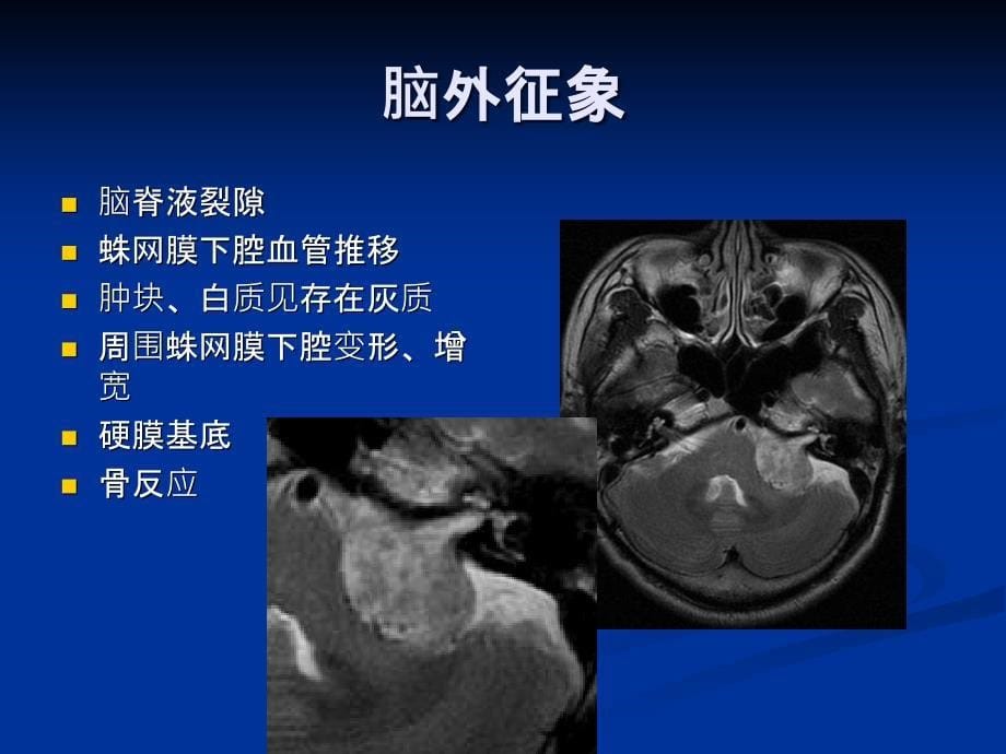 中枢神经系统影像教学片二_第5页