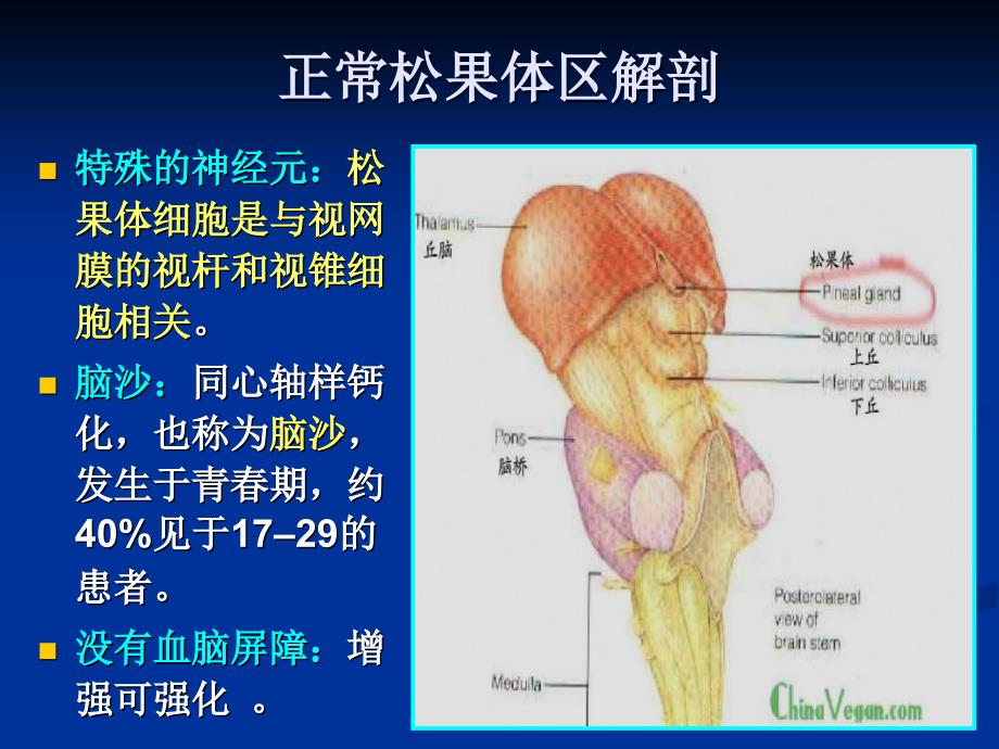 松果体区病变影像诊断PPT课件_第3页