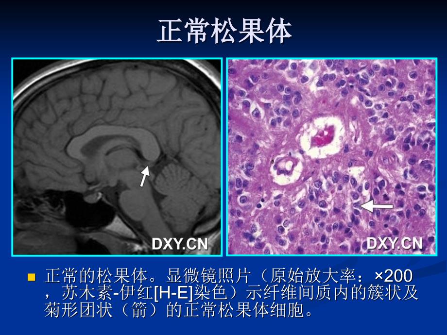 松果体区病变影像诊断PPT课件_第4页