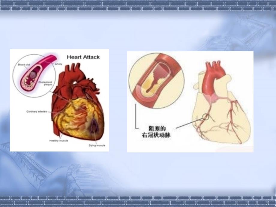 急性冠脉综合征_第3页