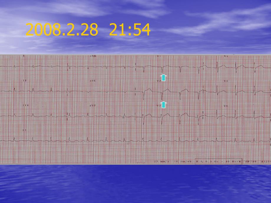 应激性心肌病StresInduced Cardiomyopathy_第3页