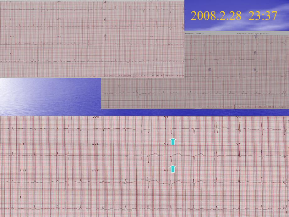 应激性心肌病StresInduced Cardiomyopathy_第4页