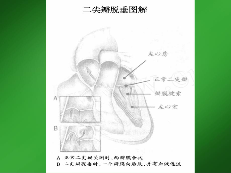 二尖瓣脱垂综合症3_第4页