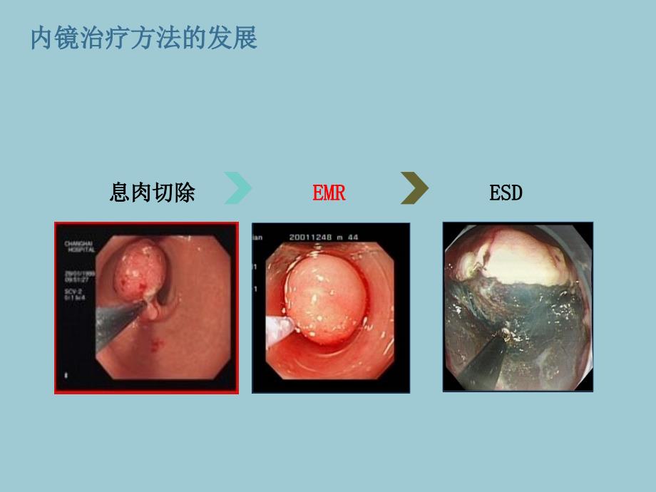 EMR内镜下黏膜切除术_第3页