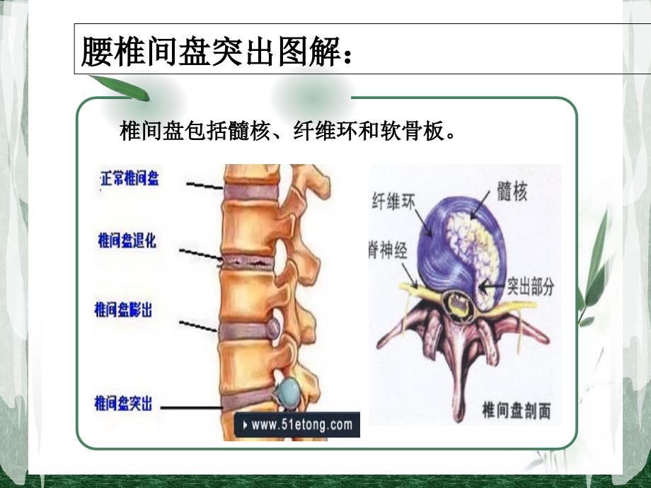 腰椎间盘突出症病人的护理查房课件_第4页