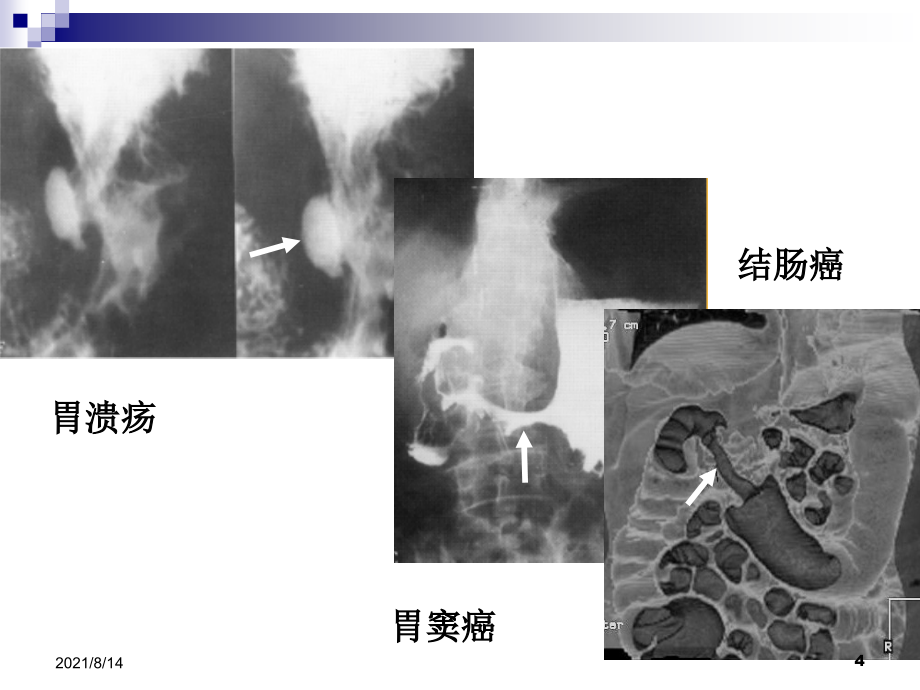 项目四：消化系统影像检查_第4页