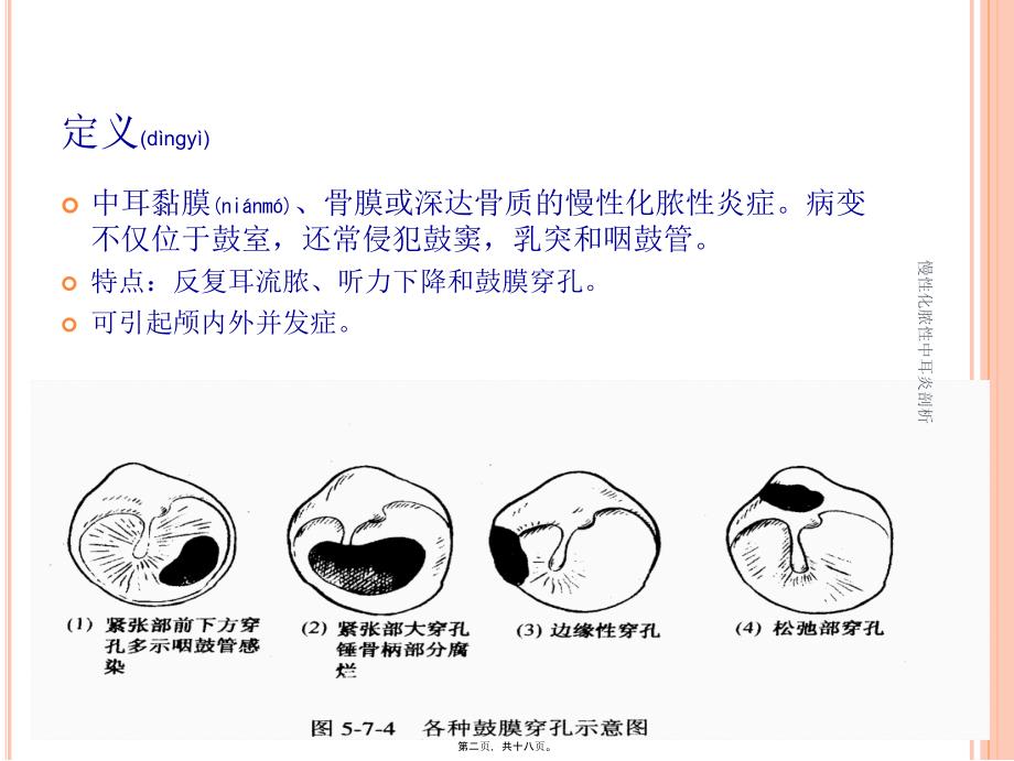 慢性化脓性中耳炎剖析课件_第2页