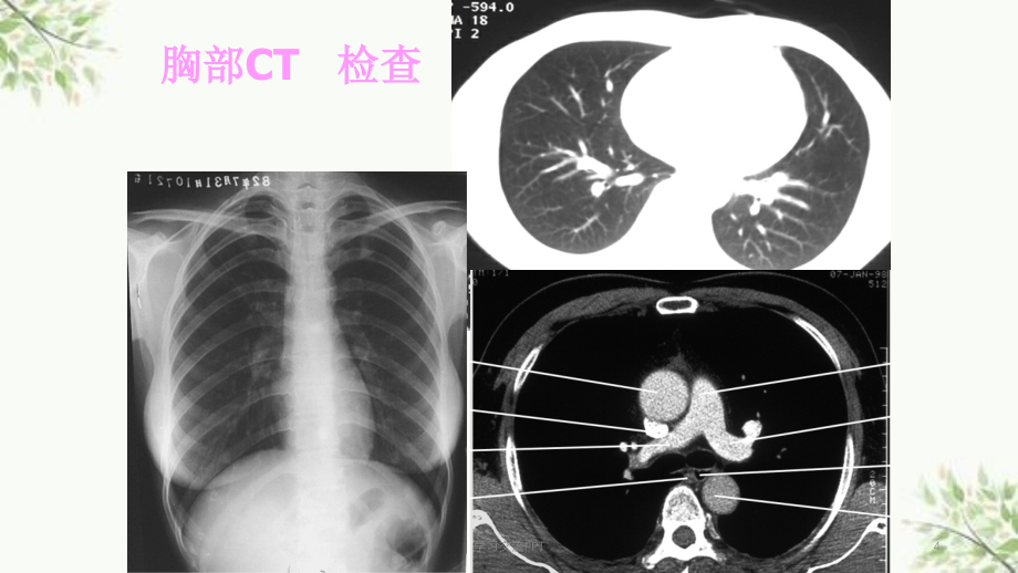 胸部CT之正常表现课件_第4页