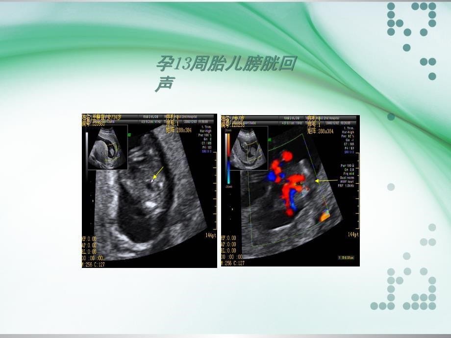 胎儿泌尿系统畸形超声诊断ppt课件_第5页