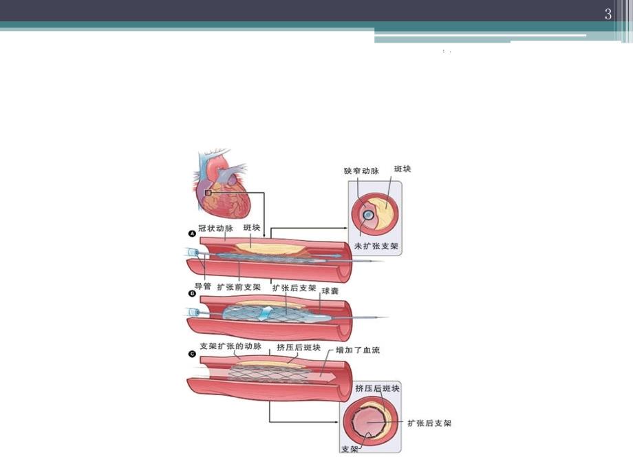 冠脉内溶栓临床应用ppt课件_第3页