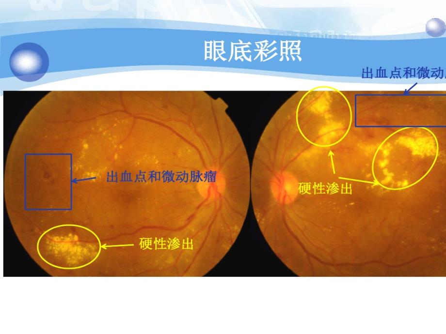 糖尿病视网膜病变 课件_第2页