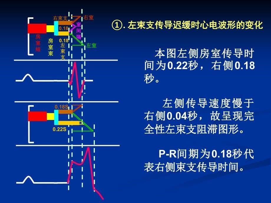 关于束支阻滞特殊心电现象的解析王永权_第5页