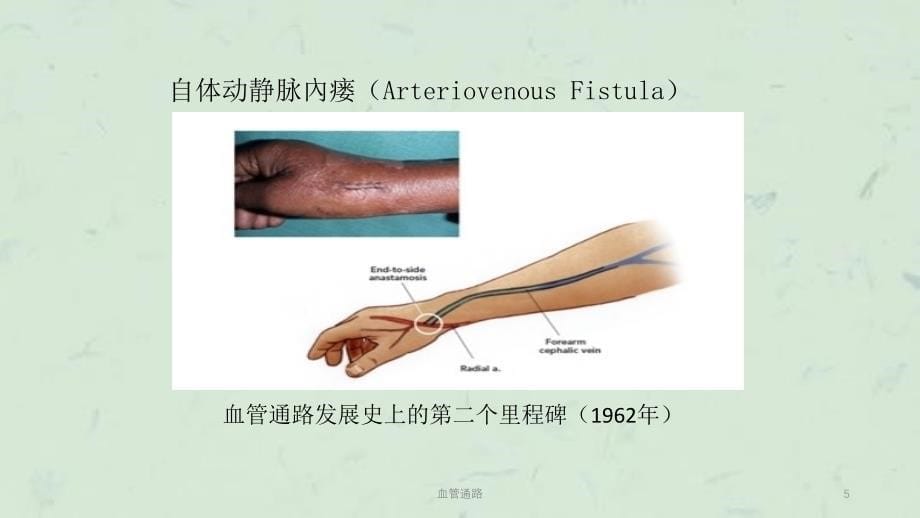 血管通路课件_第5页