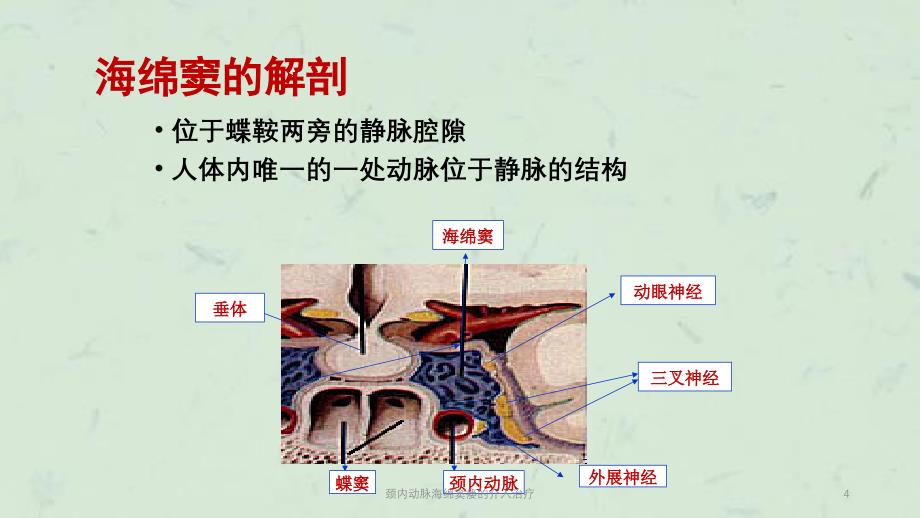 颈内动脉海绵窦瘘的介入治疗课件_第4页