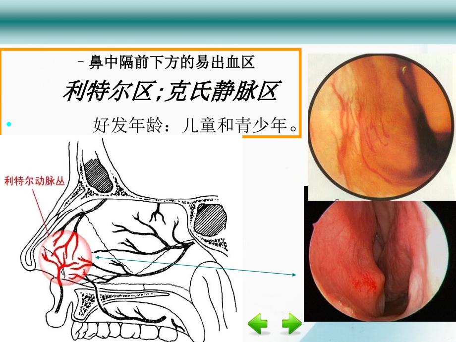 鼻出血尹兴红课件_第3页