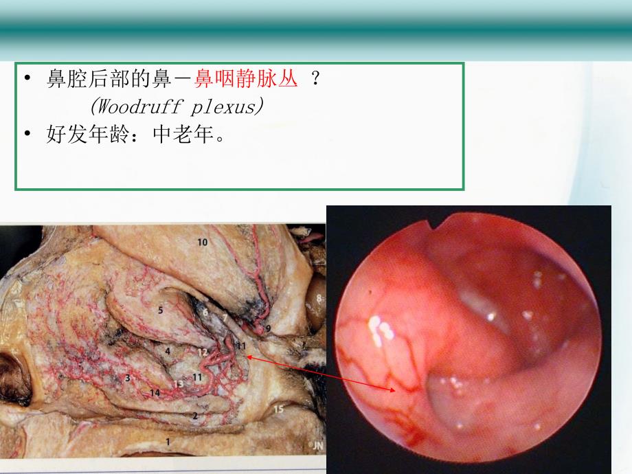 鼻出血尹兴红课件_第4页