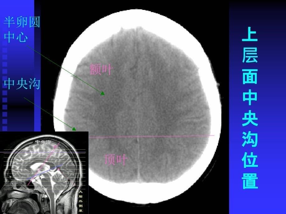 头颅磁共振MRI诊断入门知识_第5页