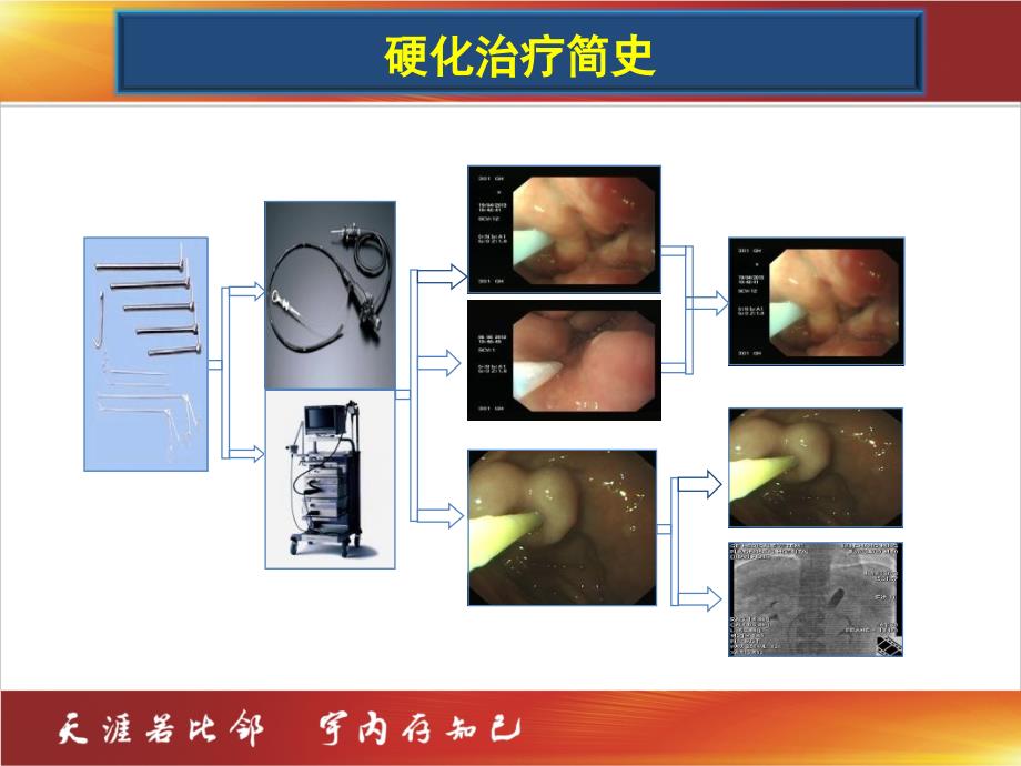 食管静脉曲张单纯硬化治疗_第4页