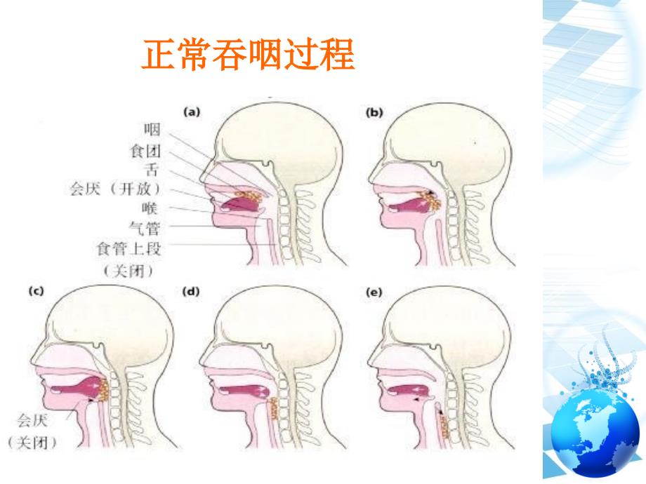 老年人住院期间误吸的预防与处理_第3页