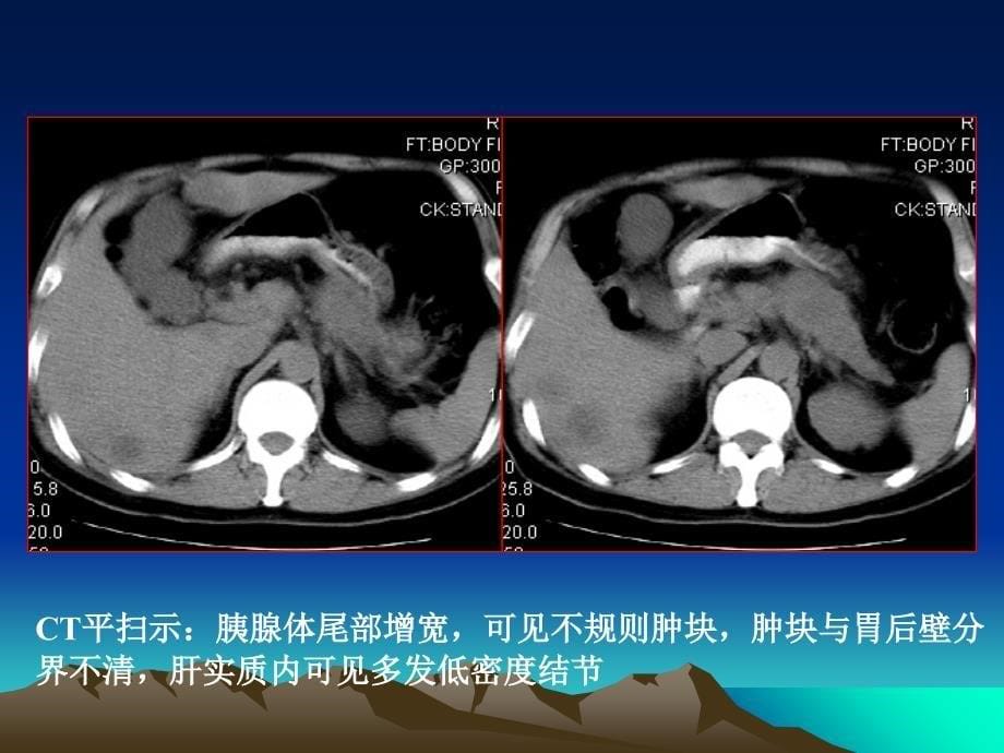 多层螺旋CT在胰腺癌诊断及_第5页