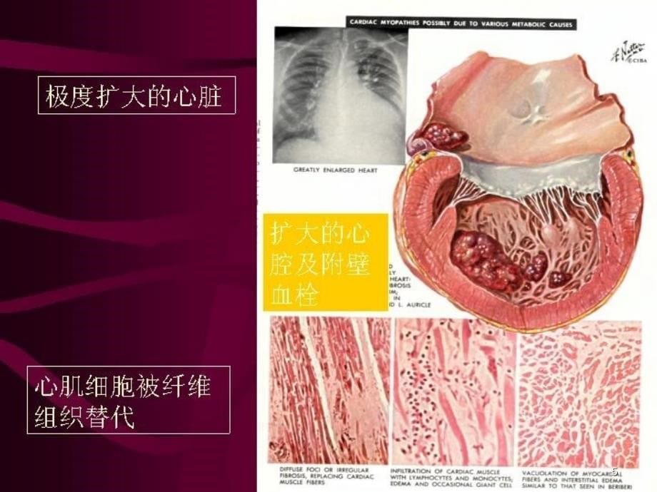 扩张型心肌病与缺血心的鉴别ppt课件_第5页